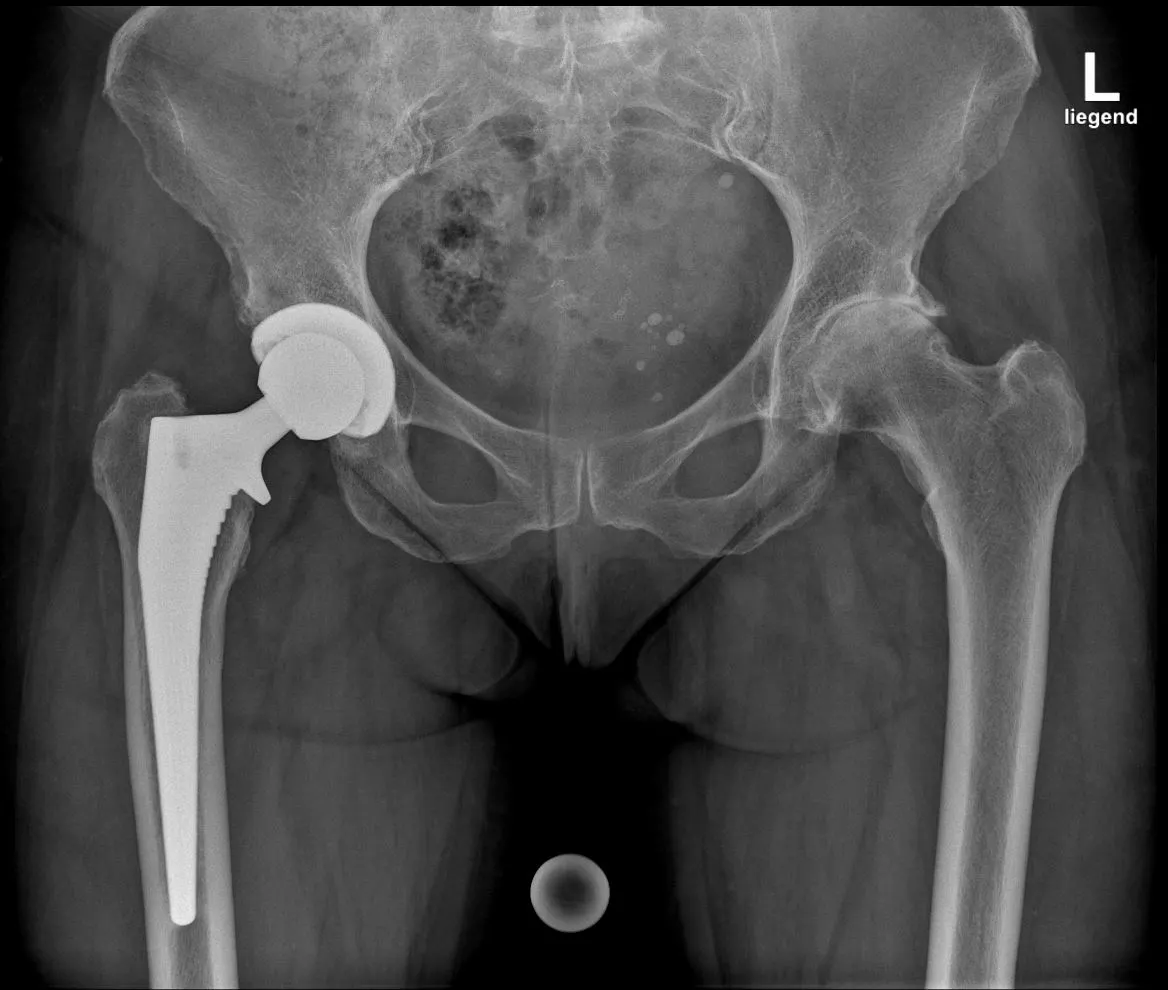 Hüftprothese Postoperativ